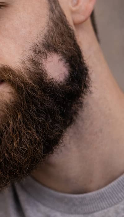 trou barbe alopécie trou barbe alopécie
