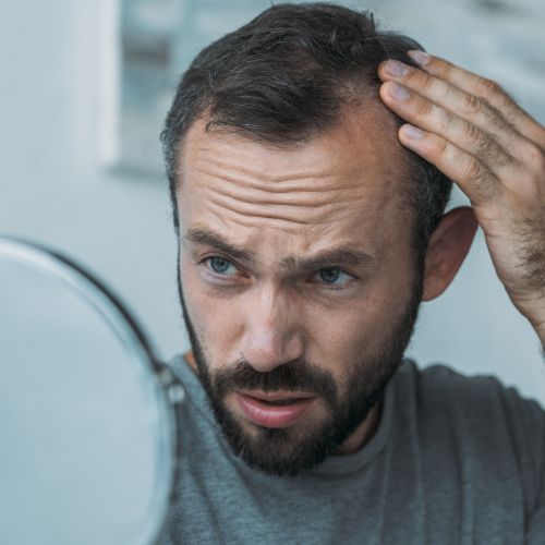 perte de cheveux homme